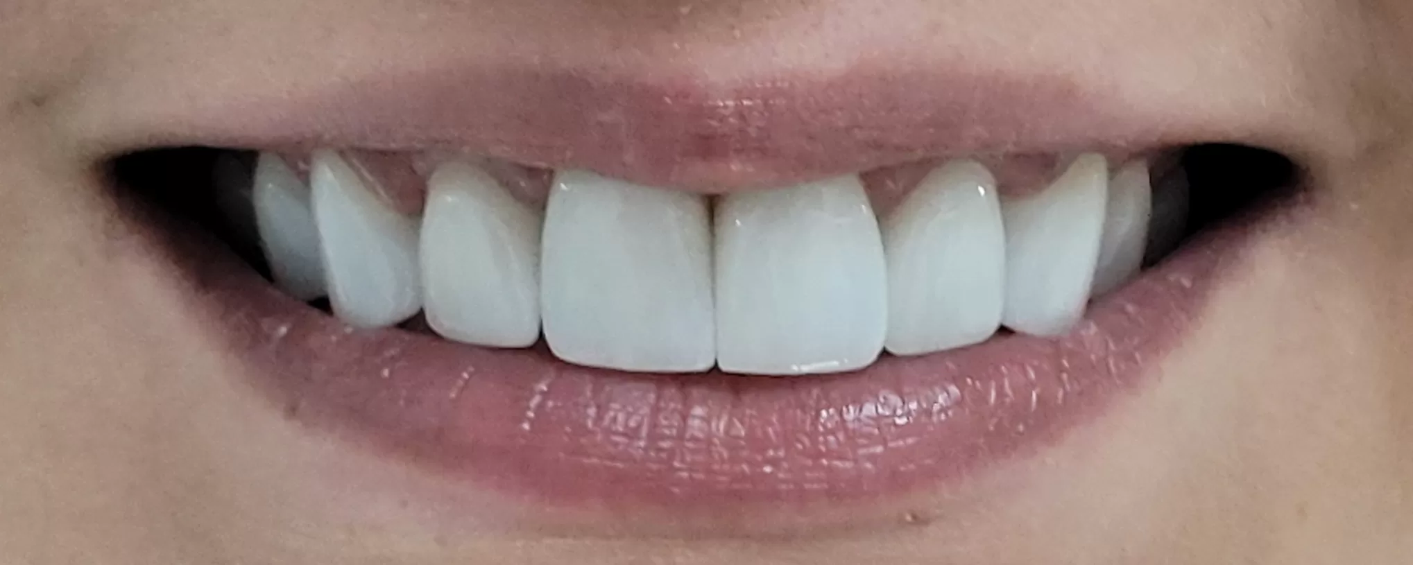 Ceramic crowns on Zirconia and dental implants - AFTER