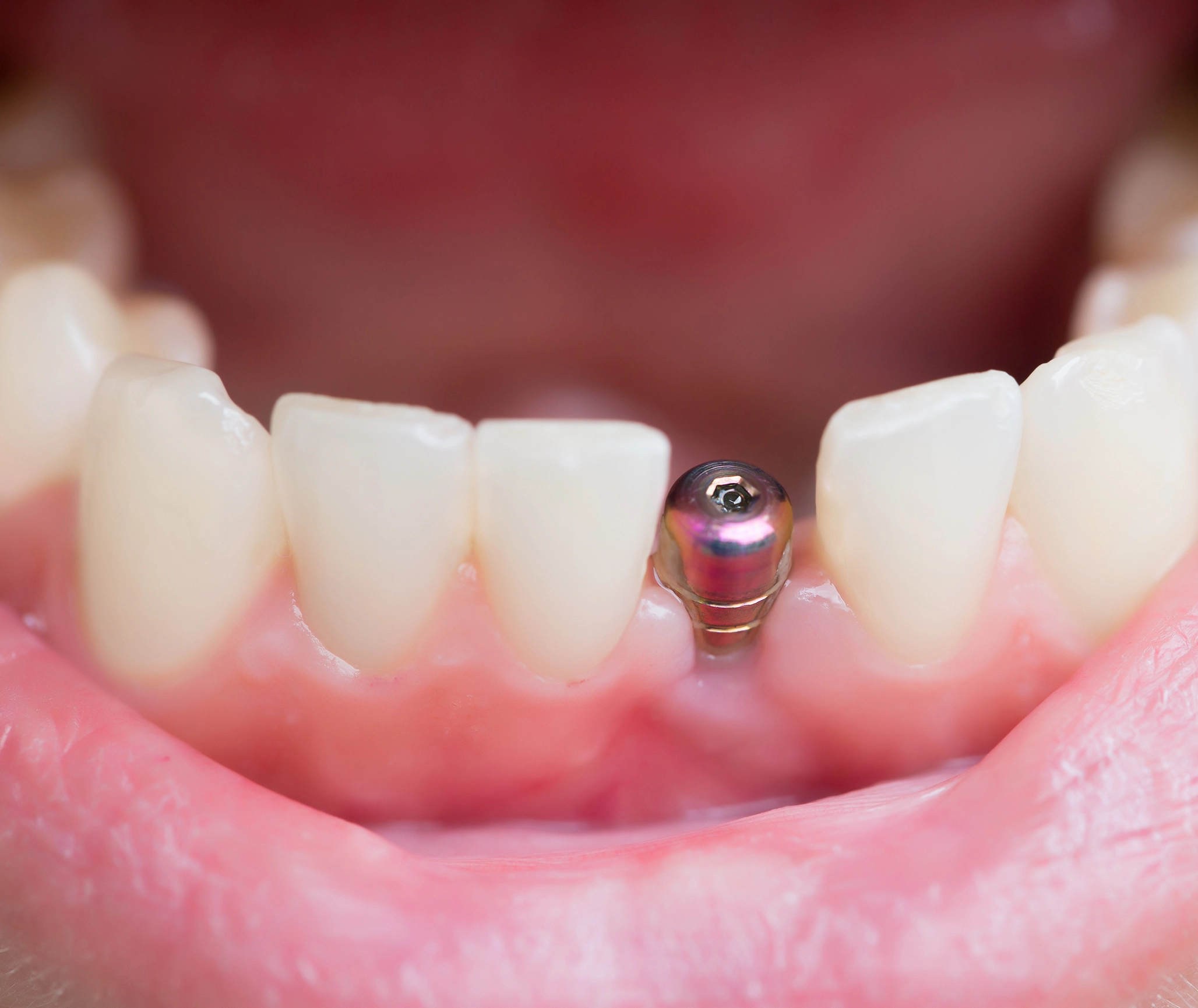 Dental Implant - dental clinic Smile Architects